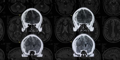 brain scans